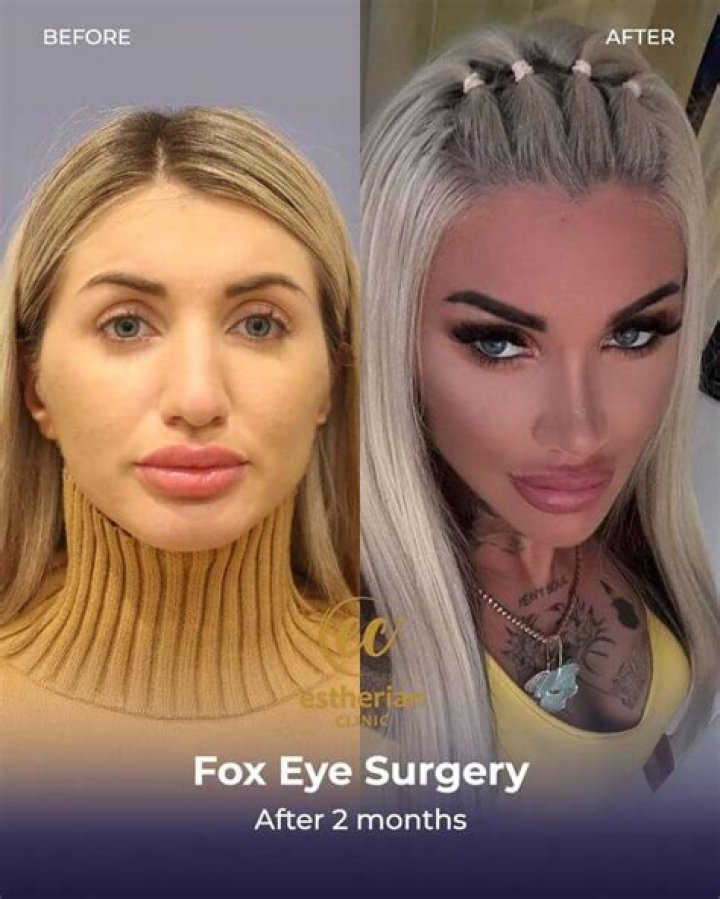 Discover The Secrets Of Fox Eye Surgery: Before And After Revealed