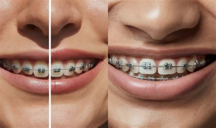 Heres Why Patricia Arquette Never Fixed Her Crooked Teeth