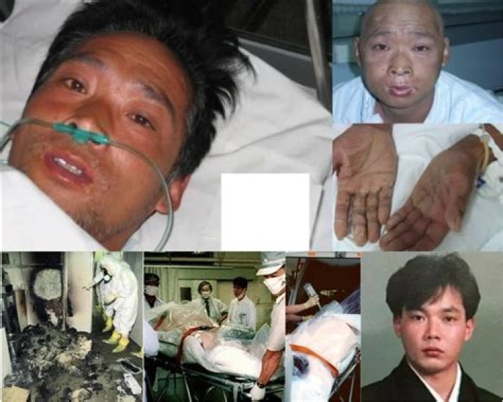 Photos: Hisashi Ouchi - The Corpse Man Who Survived Nuclear Radiation