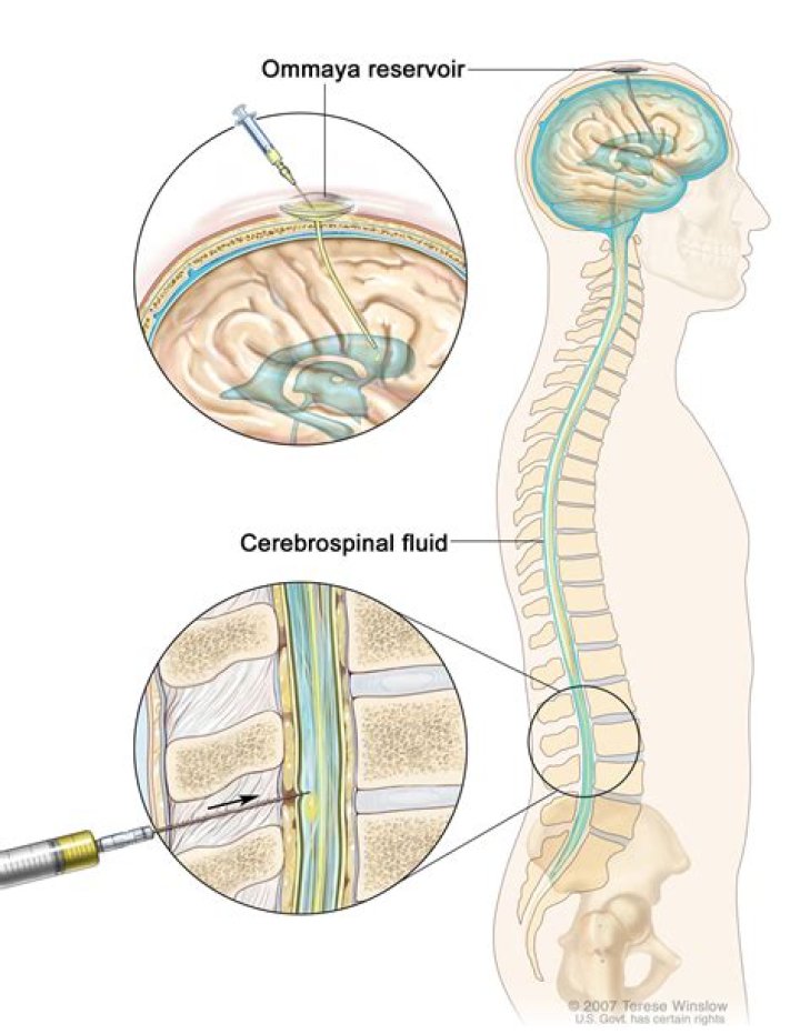 Taylor Syring: Revolutionary Spinal Fluid Management