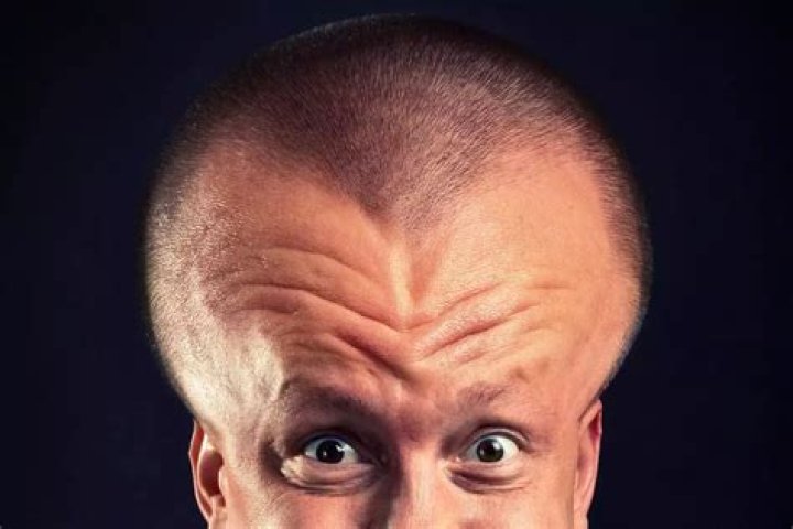 The Biggest Forehead in the World: A Fascinating Exploration