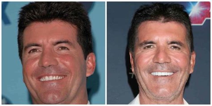 Uncovering The Secrets Behind His Veneers