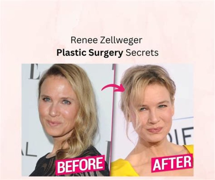 Unveiling Renee Zellweger's Cosmetic Journey: Discoveries And Revelations