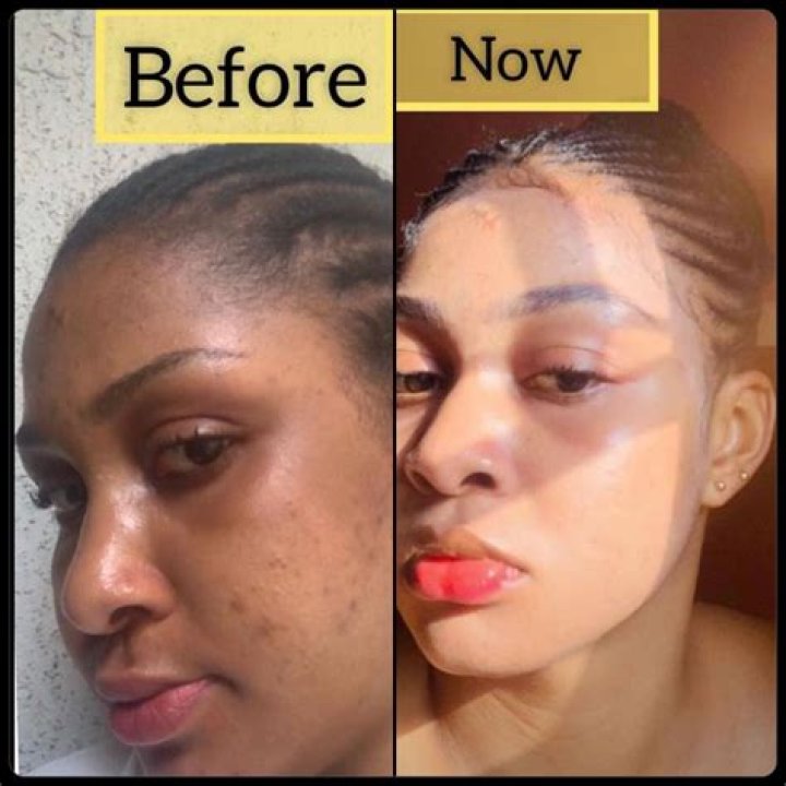 Unveiling The Health Perils Of Vybz Kartel's Skin Bleaching: Discoveries And Insights